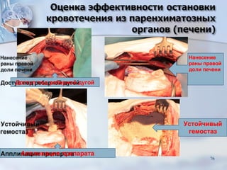 Доступ под реберной дугой
Нанесение
раны правой
доли печени
Аппликация препарата
Устойчивый
гемостаз
76
 