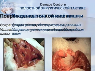 Повреждение тонкой кишки
Сокращенная обструктивная резекция
Ушивание ран непрерывным однорядным
швом
Damage Control в
ПОЛОСТНОЙ ХИРУРГИЧЕСКОЙ ТАКТИКЕ
77
 