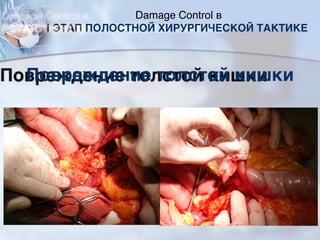 Повреждение толстой кишки
Damage Control в
I ЭТАП ПОЛОСТНОЙ ХИРУРГИЧЕСКОЙ ТАКТИКЕ
78
 