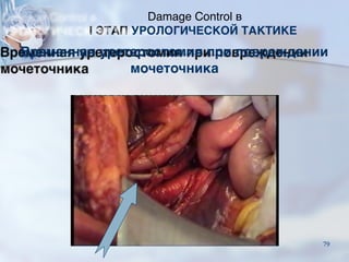 Временная уретеростомия при повреждении
мочеточника
Damage Control в
I ЭТАП УРОЛОГИЧЕСКОЙ ТАКТИКЕ
79
 