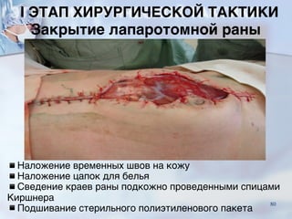 Закрытие лапаротомной раны
▪Наложение временных швов на кожу
▪Наложение цапок для белья
▪Сведение краев раны подкожно проведенными спицами
Киршнера
▪Подшивание стерильного полиэтиленового пакета
I ЭТАП ХИРУРГИЧЕСКОЙ ТАКТИКИ
80
 