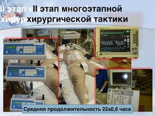 II этап многоэтапной
хирургической тактики
Средняя продолжительность 22±0,6 часа 82
 