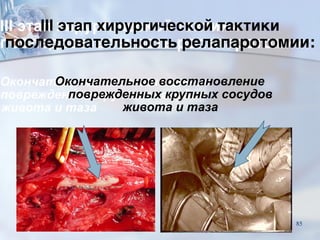 III этап хирургической тактики  
последовательность релапаротомии:
Окончательное восстановление
поврежденных крупных сосудов
живота и таза
85
 