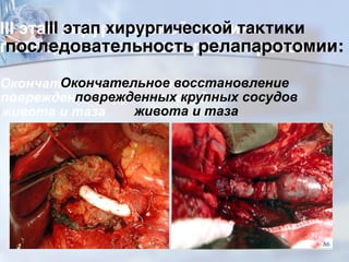 III этап хирургической тактики  
последовательность релапаротомии:
Окончательное восстановление
поврежденных крупных сосудов
живота и таза
86
 
