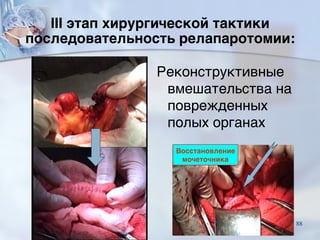 Реконструктивные
вмешательства на
поврежденных
полых органах
Восстановление
мочеточника
III этап хирургической тактики  
последовательность релапаротомии:
88
 