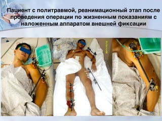 ■ Пациент с политравмой, реанимационный этап после
проведения операции по жизненным показаниям с
наложенным аппаратом внешней фиксации
90
 