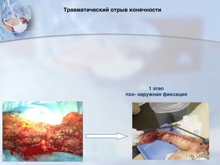 Травматический отрыв конечности
1 этап
пхо- наружная фиксация
95
 