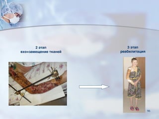 2 этап
вхо+замещение тканей
3 этап
реабилитация
96
 