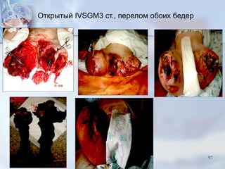 Открытый IVSGM3 ст., перелом обоих бедер
97
 