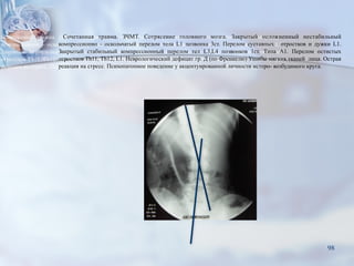 Сочетанная травма. ЗЧМТ. Сотрясение головного мозга. Закрытый осложненный нестабильный
компрессионно - оскольчатый перелом тела L1 позвонка 3ст. Перелом суставных отростков и дужки L1.
Закрытый стабильный компрессионный перелом тел L3,L4 позвонков 1ст. Типа А1. Перелом остистых
отростков Th11, Th12, L1. Неврологический дефицит гр. Д (по Френкелю) Ушибы мягких тканей лица. Острая
реакция на стресс. Психопатопное поведение у акцентуированной личности истеро- возбудимого круга.
98
 