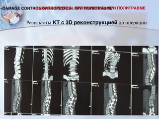 Результаты КТ с 3D реконструкцией до операции
«DAMAGE CONTROL ORTHOPEDICS» ПРИ ПОЛИТРАВМЕ
99
 