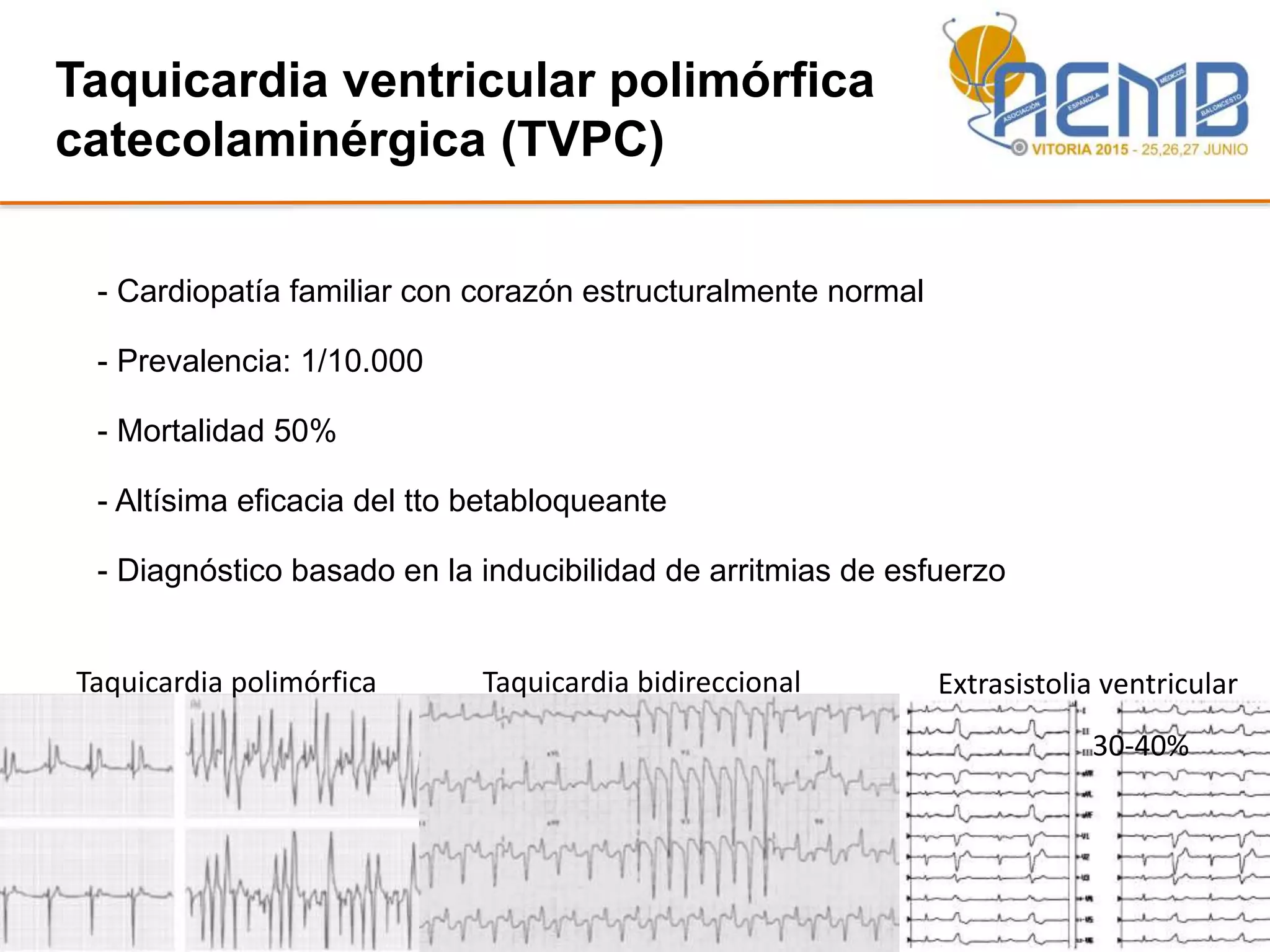 Taquicardia ventricular polimórfica
catecolaminérgica (TVPC)
Taquicardia polimórfica Taquicardia bidireccional Extrasistolia ventricular
- Cardiopatía familiar con corazón estructuralmente normal
- Prevalencia: 1/10.000
- Mortalidad 50%
- Altísima eficacia del tto betabloqueante
- Diagnóstico basado en la inducibilidad de arritmias de esfuerzo
30-40%
 