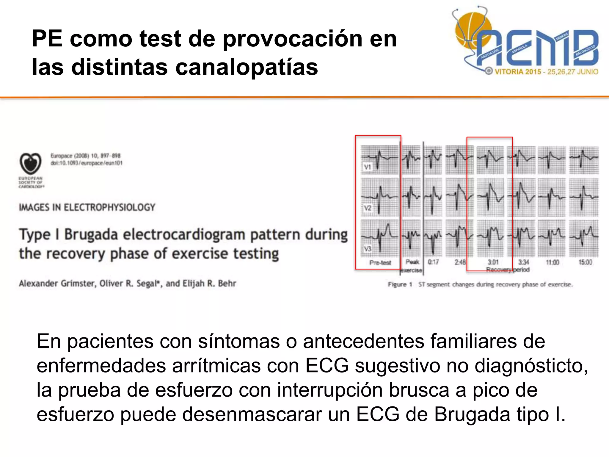En pacientes con síntomas o antecedentes familiares de
enfermedades arrítmicas con ECG sugestivo no diagnósticto,
la prueba de esfuerzo con interrupción brusca a pico de
esfuerzo puede desenmascarar un ECG de Brugada tipo I.
PE como test de provocación en
las distintas canalopatías
 