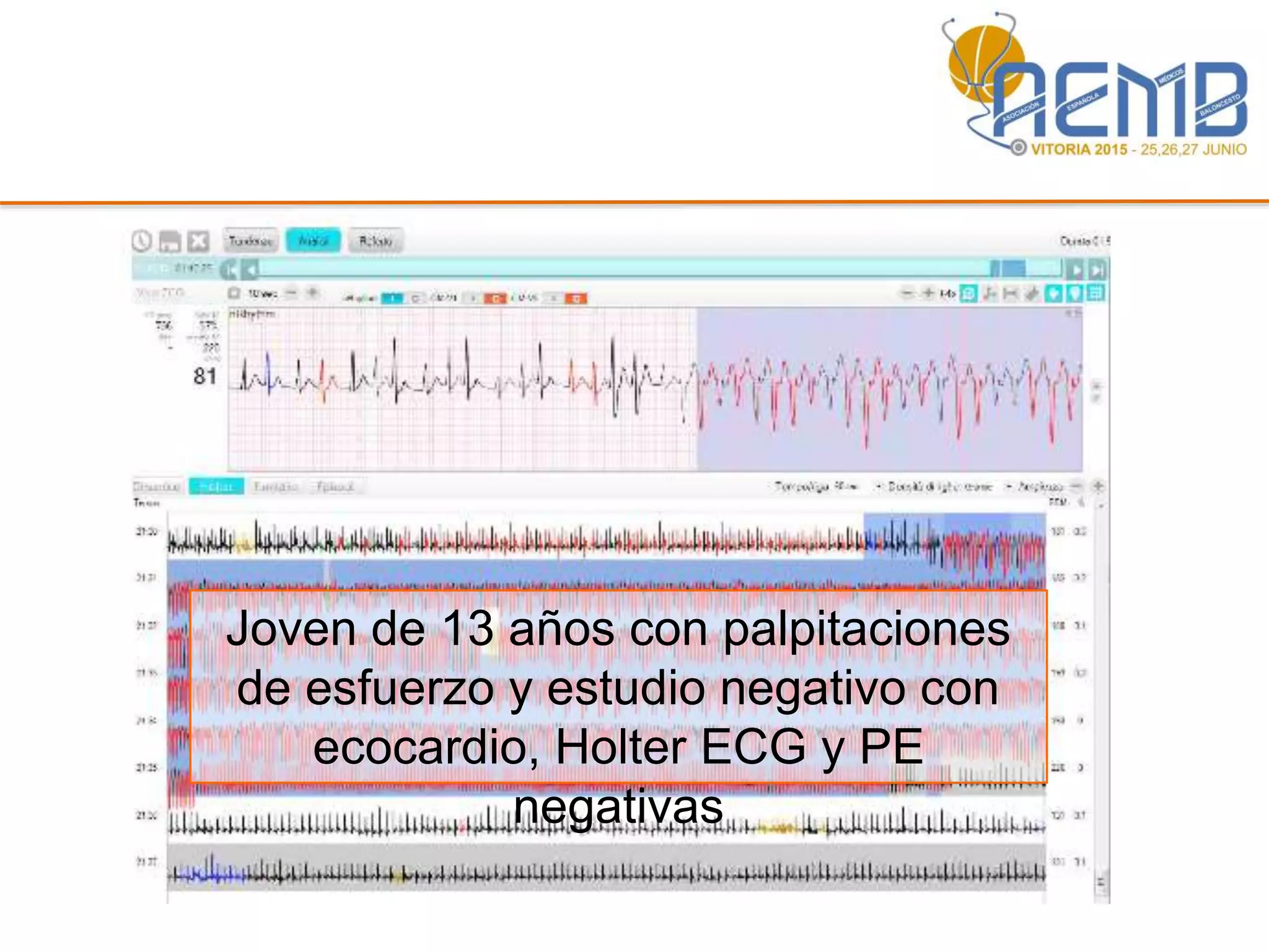 Joven de 13 años con palpitaciones
de esfuerzo y estudio negativo con
ecocardio, Holter ECG y PE
negativas
 