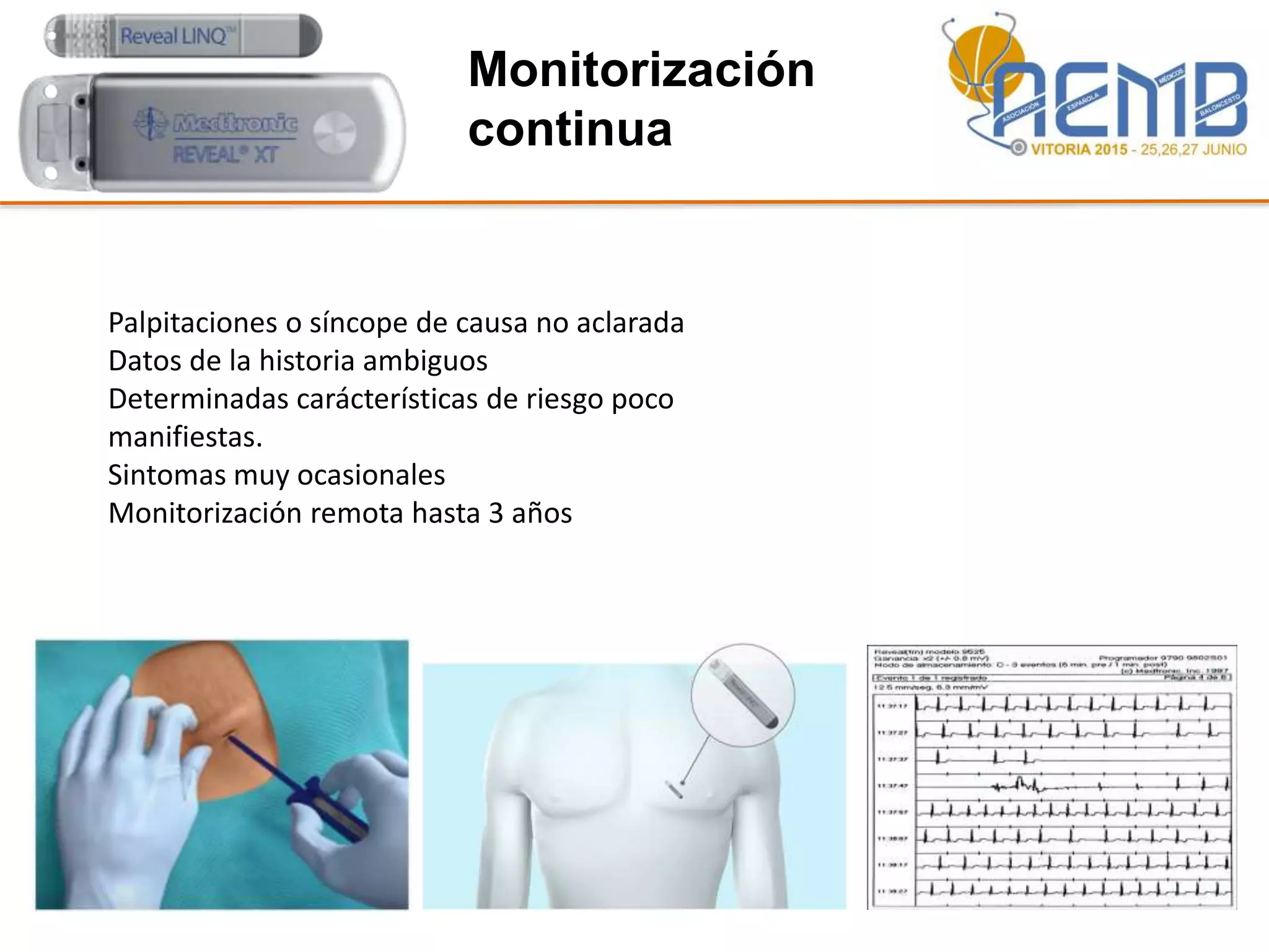 Monitorización
continua
Palpitaciones o síncope de causa no aclarada
Datos de la historia ambiguos
Determinadas carácterísticas de riesgo poco
manifiestas.
Sintomas muy ocasionales
Monitorización remota hasta 3 años
 