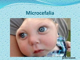 Microcefalia
 
