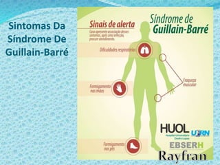Sintomas Da
Síndrome De
Guillain-Barré
 