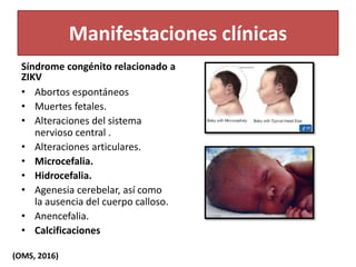 Manifestaciones clínicas
Síndrome congénito relacionado a
ZIKV
• Abortos espontáneos
• Muertes fetales.
• Alteraciones del sistema
nervioso central .
• Alteraciones articulares.
• Microcefalia.
• Hidrocefalia.
• Agenesia cerebelar, así como
la ausencia del cuerpo calloso.
• Anencefalia.
• Calcificaciones
(OMS, 2016)
 
