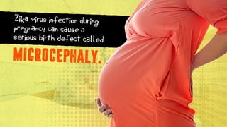 Zika virus infection during
pregnancy can cause a
serious birth defect called
MICROCEPHALY.
 