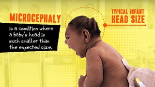 TYPICAL INFANT
HEAD SIZE
is a condition where
a baby’s head is
much smaller than
the expected size.
MICROCEPHALY
 