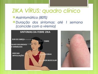 ZIKA VÍRUS: quadro clínico
 Assintomático (80%)
 Duração dos sintomas: até 1 semana
(coincide com a viremia)
 