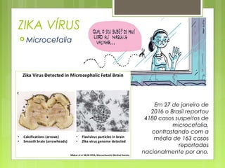 ZIKA VÍRUS
 Microcefalia
Em 27 de janeiro de
2016 o Brasil reportou
4180 casos suspeitos de
microcefalia,
contrastando com a
média de 163 casos
reportados
nacionalmente por ano.
 