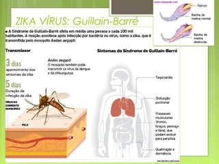 ZIKA VÍRUS: Guillain-Barré
 