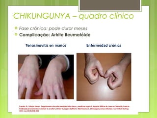 CHIKUNGUNYA – quadro clínico
 Fase crônica: pode durar meses
 Complicação: Artrite Reumatóide
 