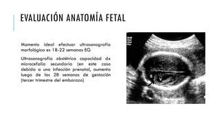 EVALUACIÓN ANATOMÍA FETAL
Momento ideal efectuar ultrasonografía
morfológica es 18-22 semanas EG
Ultrasonografía obstétrica capacidad dx
microcefalia secundaria (en este caso
debida a una infección prenatal, aumenta
luego de las 28 semanas de gestación
(tercer trimestre del embarazo)
 