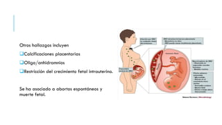Otros hallazgos incluyen
Calcificaciones placentarias
Oligo/anhidramnios
Restricción del crecimiento fetal intrauterino.
Se ha asociado a abortos espontáneos y
muerte fetal.
 