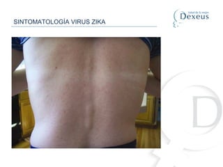 Address for correspondence: Brian D. Foy, Arthropod-borne and Infectious Diseases Laboratory, Depa
of Microbiology, Immunology and Pathology, Colorado State University, Fort Collins, CO, USA, 805
email: brian.foy@colostate.edu
Figure. Maculopapular rash on patient 3 infected with Zika virus, Colorado, USA.
SINTOMATOLOGÍA VIRUS ZIKA
 