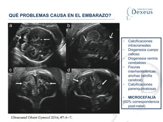 QUÉ PROBLEMAS CAUSA EN EL EMBARAZO?
- Calcificaciones
intracraneales
- Disgenesia cuerpo
calloso
- Disgenesia vermis
cerebeloso
- Fisuras
interhemisféricas
anchas (atrofia
cerebral)
- Calcificaciones
parenquimatosas
- MICROCEFALIA
(60% correspondencia
post-natal)
 