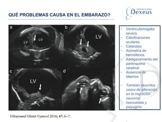 QUÉ PROBLEMAS CAUSA EN EL EMBARAZO?
- Ventriculomegalia
severa
- Calcificaciones
oculares
- Cataratas
- Asimetría de
hemisferios
- Adelgazamiento del
parénquima
cerebral
- Ausencia de
tálamos
- También descritos
casos de alteración
en la migración
neuronal:
lisencefalia y
paquigiria
 
