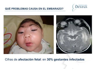 QUÉ PROBLEMAS CAUSA EN EL EMBARAZO?
Cifras de afectación fetal: en 30% gestantes infectadas
 