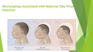 Microcephaly Associated with Maternal Zika Virus
Infection
 