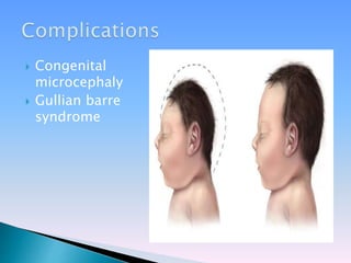  Congenital
microcephaly
 Gullian barre
syndrome
 