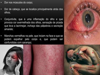 • Dor nos músculos do corpo;
• Dor de cabeça, que se localiza principalmente atrás dos
olhos;
• Conjuntivite, que é uma inflamação do olho e que
provoca cor avermelhada dos olhos, sensação de picada
que leva a lacrimejar, inchaço das pálpebras e secreção
amarela;
• Manchas vermelhas na pele, que inciam na face e que se
podem espalhar pelo corpo e, que podem ser
confundidas com sarampo;
 