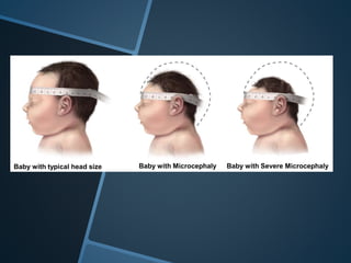 Baby with typical head size Baby with Microcephaly Baby with Severe Microcephaly
 