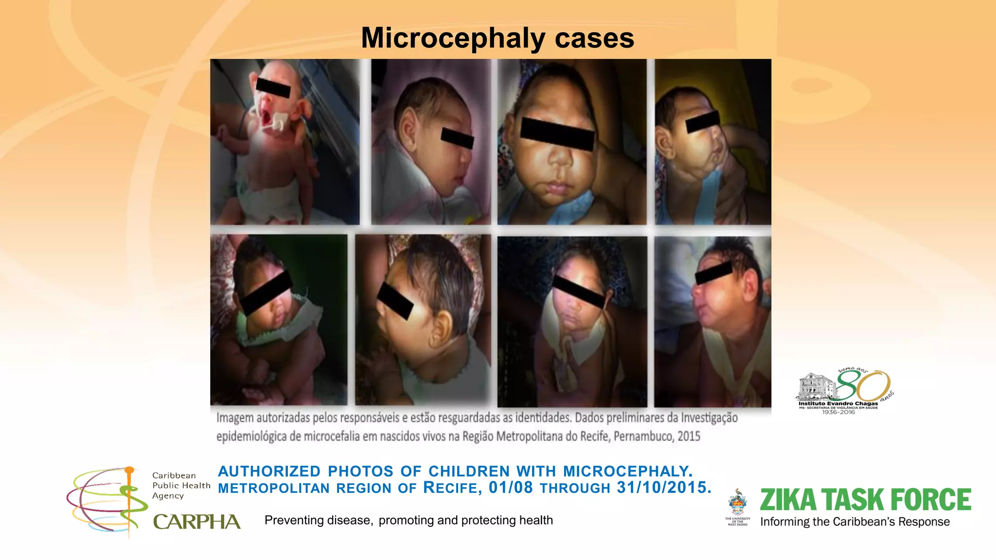 Preventing disease, promoting and protecting health
AUTHORIZED PHOTOS OF CHILDREN WITH MICROCEPHALY.
METROPOLITAN REGION OF RECIFE, 01/08 THROUGH 31/10/2015.
Microcephaly cases
 