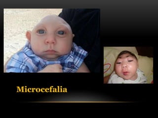 Microcefalia
 