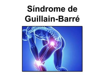 Síndrome de
Guillain-Barré
 