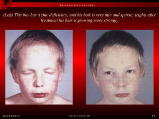 B io l o g ic a l F u n c t io n o f Z in c



(Left) This boy has a zinc deficiency, and his hair is very thin and sparse; (right) after
                      treatment his hair is growing more strongly




Ju n e 2 6 , 2 0 1 2                        T o t a l s l id e s : 7 8                 27
 