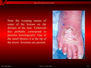 B io l o g ic a l F u n c t io n o f Z in c




           Note the weeping nature of
            some of the lesions on the
            dorsum of the foot. Yellowish
            foci probably correspond to
            pustules histologically. One of
            the small blisters it at the tip of
            the arrow. Erosions are present.




Ju n e 2 6 , 2 0 1 2                           T o t a l s l id e s : 7 8         73
 
