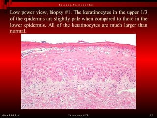 B io l o g ic a l F u n c t io n o f Z in c


       Low power view, biopsy #1. The keratinocytes in the upper 1/3
        of the epidermis are slightly pale when compared to those in the
        lower epidermis. All of the keratinocytes are much larger than
        normal.




Ju n e 2 6 , 2 0 1 2                     T o t a l s l id e s : 7 8         74
 