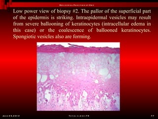 B io l o g ic a l F u n c t io n o f Z in c

           Low power view of biopsy #2. The pallor of the superficial part
            of the epidermis is striking. Intraepidermal vesicles may result
            from severe ballooning of keratinocytes (intracellular edema in
            this case) or the coalescence of ballooned keratinocytes.
            Spongiotic vesicles also are forming.




Ju n e 2 6 , 2 0 1 2                        T o t a l s l id e s : 7 8         77
 