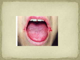  Riboflavin deficiency
 Magenta Tongue, Angular cheilosis, Seborrhoea and
cheilosis
 Flavin Mononucleotide and Flavin A...