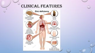 CLINICAL FEATURES
 