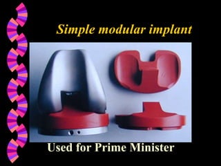 Simple modular implant
Used for Prime Minister
 