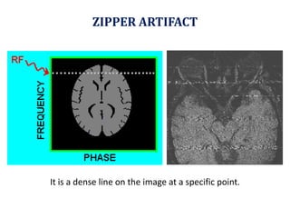 ZIPPER ARTIFACT It is a dense line on the image at a specific point. 