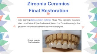 Zirconia Ceramics
Final Restoration
• After applying glaze and stain materials (Glaze Plus, stain color tissue and
stain color Prettau A1) on fired ceramic layers (Ice Zirkon Ceramics) a final
prosthetic restoration is obtained as seen in the figure.
Zirconia ceramics
final restoration
 